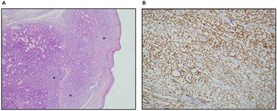 An H-TERT Mutated Skin Metastasis as First Occurrence in a Case of Follicular Thyroid Carcinoma